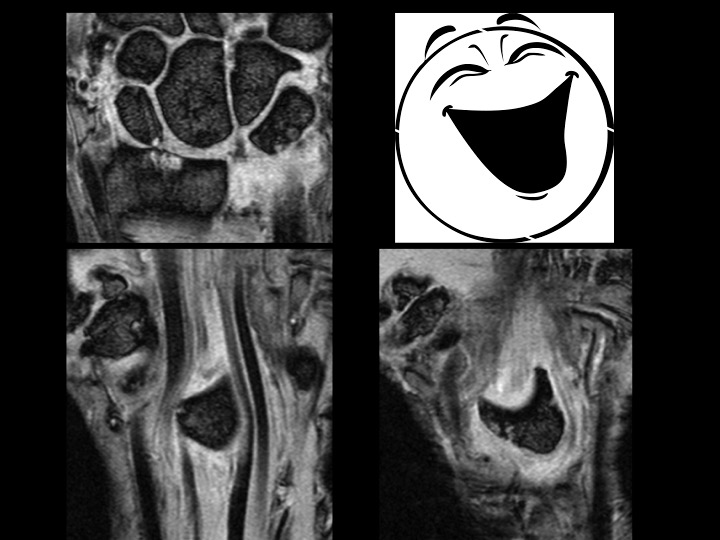 Figure 3 for case Lunate dislocation